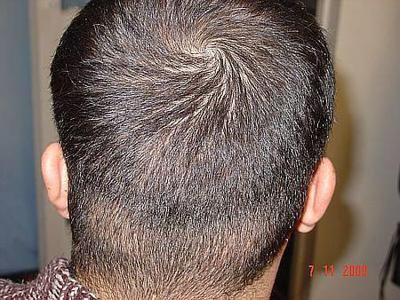 Follicular Unit Grafting 