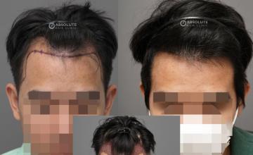 Dr. Kongkiat Laorwong, MD, FISHRS,  FUE 2100 grafts, 5 months post