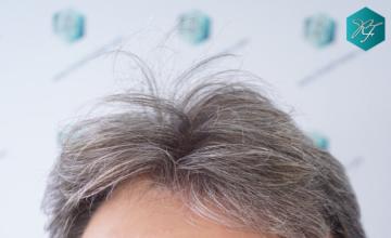 Rafael de Freitas - NW2/3 GRAY AND VERY FINE HAIR - 3.220 Grafts