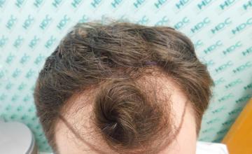Result for 3300 grafts on NW 3 patient – 7 Months after – HDC Hair Clinic