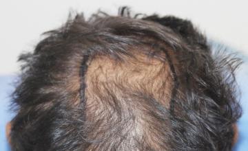 Dr. Suneet Soni - 4700 Grafts, FUT+FUE & Beard Combination