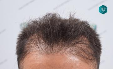Dr. Rafael de Freitas -  REPAIR CASE:  2.312 + 1.117 = 3.429 Grafts