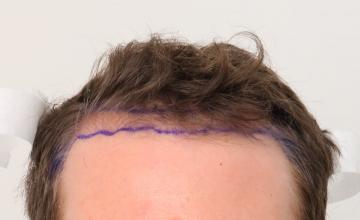 Dr. Robert Dorin ~ 1900 Graft FUT ~ 10th month
