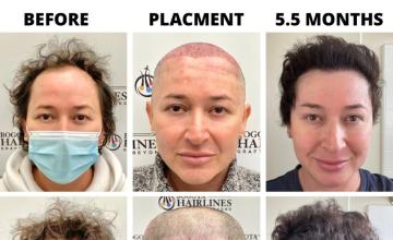 Transgender HT Bogota Hairlines - Dr Sergio Camacho 3046 Grafts EARLY GROWER!