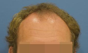 Dr Timothy Carman 2055 FU Grafts One Year result.