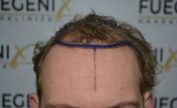 Dr. Munib Ahmad - 2480g Soft Dense Hairline -  Light Blond Wavy Hair - FueGenix - The Netherlands