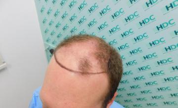 7650 grafts - Hair Transplant Result – 2 Sessions – 1 year - Class 5-6 Patient