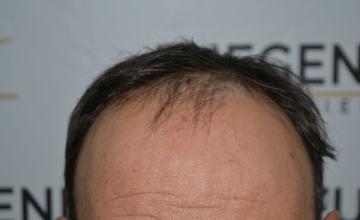 Dr. Munib Ahmad - 2415g - Salt and Pepper hairline - FueGenix - The Netherlands [UPDATE: VIDEO COMBTHROUGH]