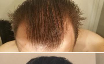 2227 FUE Grafts / Dr. Nader / Reynosa, Mexico