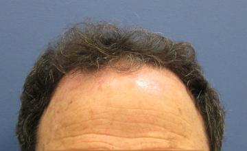 Dr Timothy Carman 2745 FU Grafts; 14 month FU