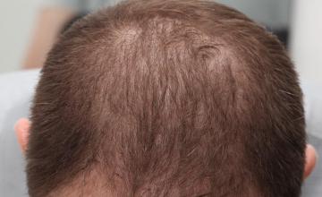Dr. Kongkiat Laorwong, MD, FISHRS,  FUE 2475 grafts Frontal area, 6 months result plus Finasteride