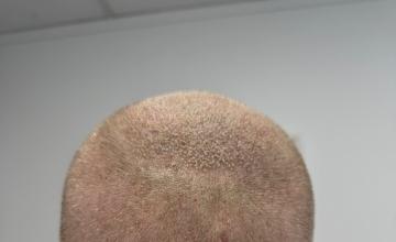 9001 Scalp Grafts 2 days Dr Ruk