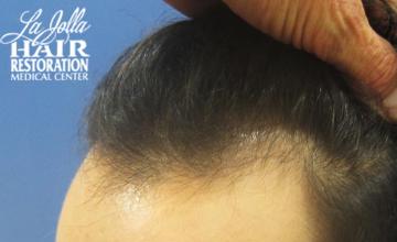 Dr Carman 1498 FU Grafts; 14 Month Result