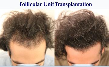 #BAM New Year. New Long Hair (3001 FUT grafts): Carlos K. Wesley, M.D. (NYC & LA)
