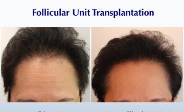 #BAM Improving a Woman's Hair Density (1882 grafts): Carlos K. Wesley, M.D. (NYC & LA)