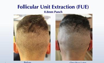 #BAM Shaved to "O" FUE Donor (2514 FUE grafts): Carlos K. Wesley, M.D. (NYC & LA)