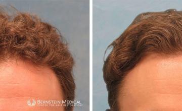 Norwood Class 3V 1,760 and 1,428 Grafts FUE-R - Dr. Robert Bernstein