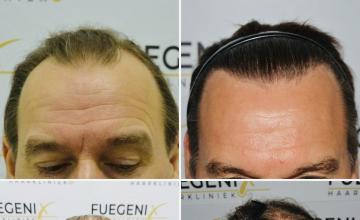 Before and After front and Top view