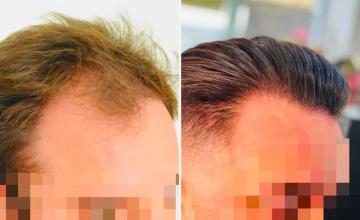 FUE hair transplant 3200 grafts with Hattingen Hair in Switzerland