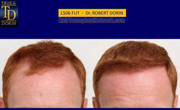Hair transplantation surgery before and after pictures