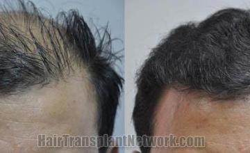 Front view - Before and after 