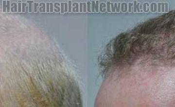  before and after pictures