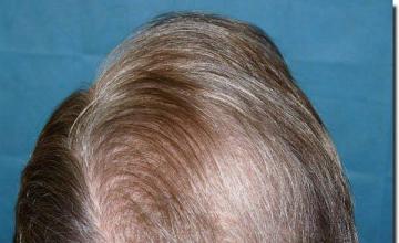 Hair restoration procedure results