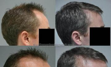 Hair restoration procedure before and after results