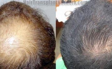 Hair restoration pictures left side views before and after
