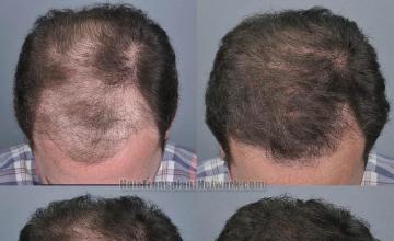  before and after photos