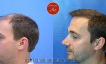 before and after photos