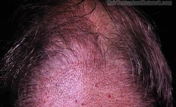 Hair restoration surgery before and after photos