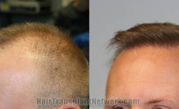  before and after result photographs