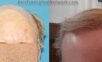 Front view - Before and after  