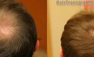Hair transplantation surgery before and after photos