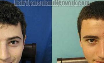 Before and after hair restoration procedure images