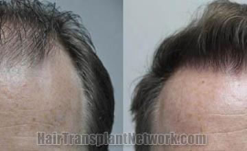 Front view - Before and after  