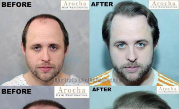 Front view - Before and after  