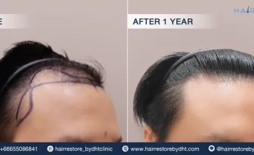 Before and After
