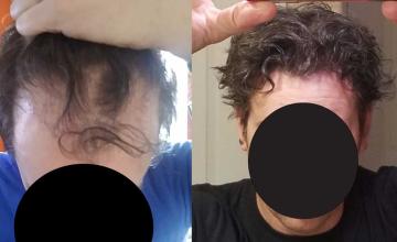 Front before and after FUE surgery