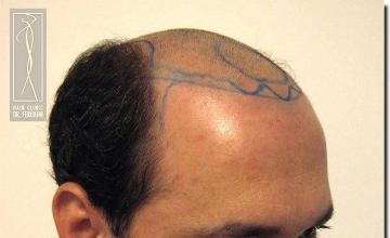 Hair restoration procedure results