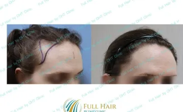 Before and After Side View