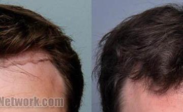 Front view - Before and after  