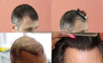 Hair restoration procedure before and after results